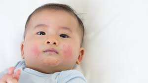 baby hives symptoms causes and