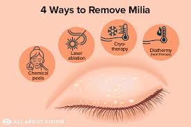 milia causes and treatment all about
