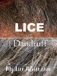 lice vs dandruff 7 key differences