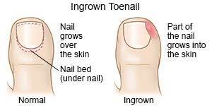 partial nail avulsion for ingrown nail