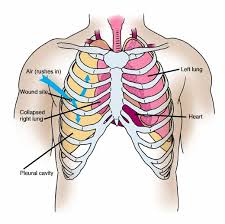 Of the two chest muscles, the pectoralis major (a.k.a. Anatomy Atlases Anatomy Of First Aid A Case Study Approach Sucking Chest Wound