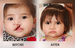 cleft lip palate repair surgery
