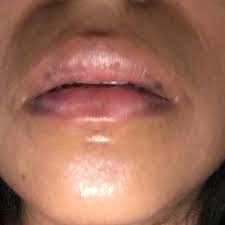 after fillers with restylane