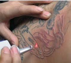 laser tattoo removal ल जर ट ट र म वल