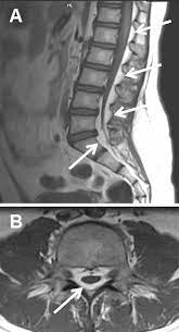 spinal epidural lipomatosis