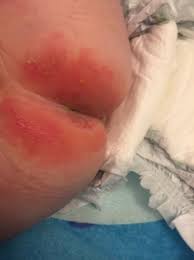 bad bad diaper rash picture update