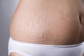 stretch marks why they appear how to