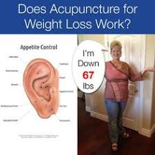 Acupuncture For Weight Loss