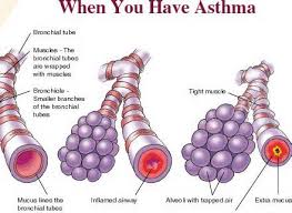 This test can't usually be done with a. Diagnosing Asthma Airbetter Org