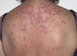 autoimmune rash causes conditions and