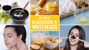 remove blackheads and whiteheads