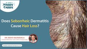 does seborrheic dermais cause hair loss