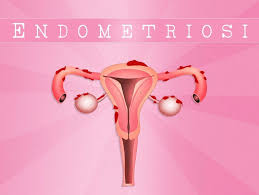 Check spelling or type a new query. What Are The Stages Of Endometriosis