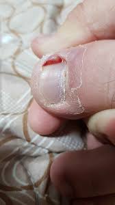 treat a blister at the toe photo