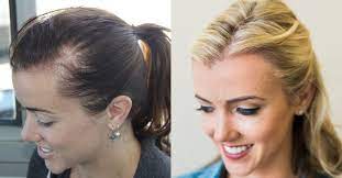 Mar 07, 2021 · before & after photos. Female Hair Transplant Reviews Hair Loss Treatment Female Styleoflady