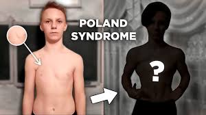 It usually affects half of the chest and presents associated abnormalities, of varying. Poland Syndrome Motivation Youtube