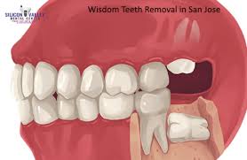 wisdom teeth removal san jose cost