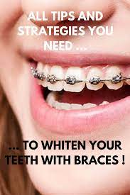 Teeth whitening with braces is one of the main concerns of people wearing braces and carring about how beautiful their smile is. Pin On Teeth Whitening How To Guides