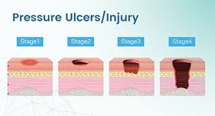 pressure ulcers injury ekare inc