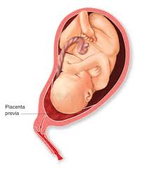 Often the types of placenta previa determine the intensity of bleeding and severity of the condition. Placenta Previa Low Placenta During Pregnancy Best Gynaecologist In Trivandrum