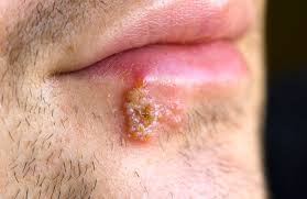 Oral herpes involves the face or mouth. Herpes Aidsmap