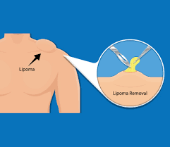 lipoma treatment types removal