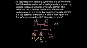 Pedigree Problem Nystagmus As A Result Of Turners Syndrome