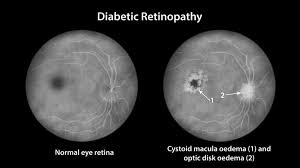 cystoid macular edema macon retina