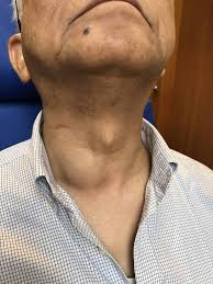 neck lump issues in singapore