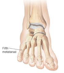 When i broke my foot i had a fibreglass cast, which meant i could still swim and do a lot of things. Understanding Fifth Metatarsal Fracture