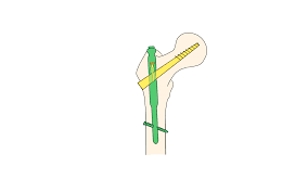 fractured neck of femur fnof