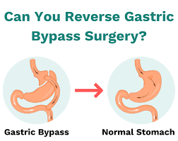 gastric byp reversal what happens