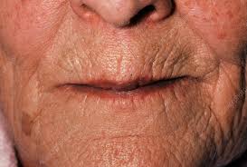 elderly woman s lips purple due to