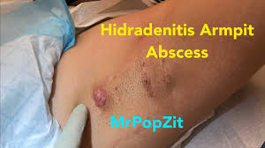 hidradenitis suppurativa armpit abscess