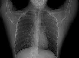 Explore your reconstruction options for poland syndrome surgery and treatment. Poland Syndrome Radiology Case Radiopaedia Org
