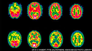 A drug for Alzheimer's disease that seems to work