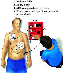 Brief introduction to automated external defibrillator (aed). Automated External Defibrillators In The Public Domain Circulation