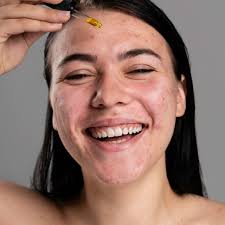 tips for acne and problematic skin