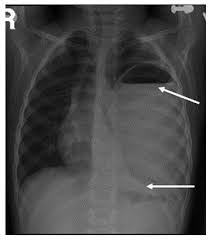 lung abscess case