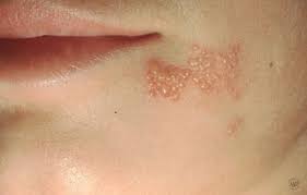herpes simplex pariser dermatology