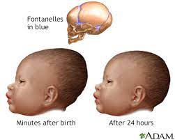 newborn head molding information