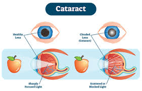 lens implants and cataract surgery