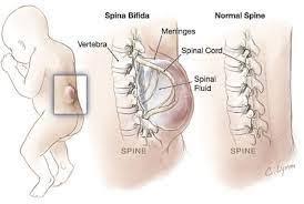 spina bifida kinetic physical therapy