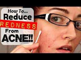 remove redness from acne scarring