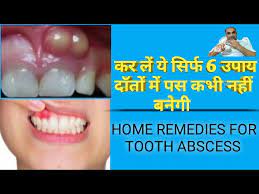 top 6 home remes for tooth abscess