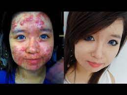 acne coverage tutorials on you