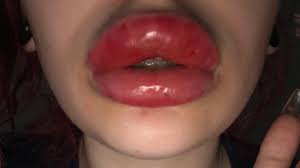 botched lip injections leave arizona