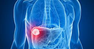 liver cancer treatment in hyderabad or