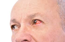 what causes red eye florida eye care