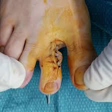 la fractura del dedo del pie